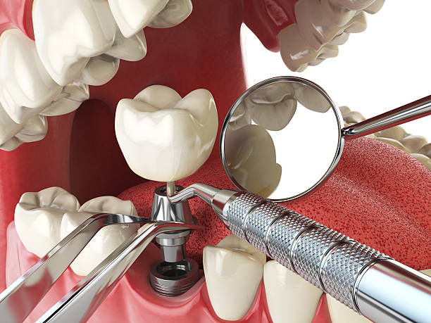 Best Emergency Root Canal Treatment in Murphy, MO